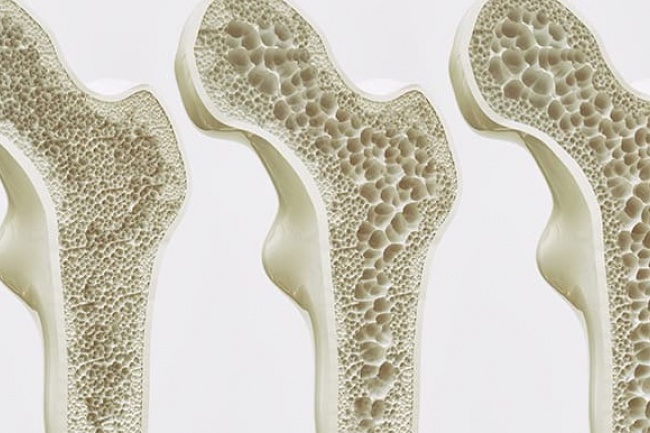 Todo paciente com osteopenia ou osteoporose precisar suplementar cálcio?