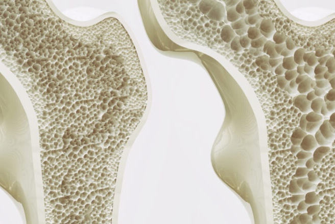 Osteoporose tem cura?