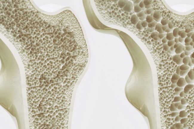 Osteoporose tem cura?