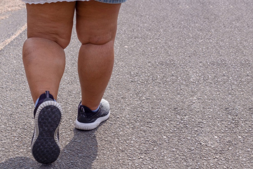 Quais são as opções de tratamento para o Lipedema?