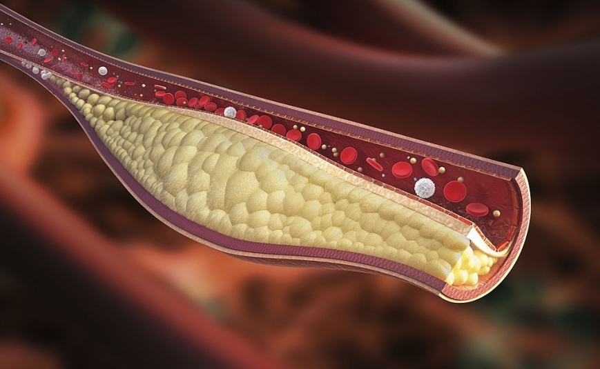 Dislipidemia 